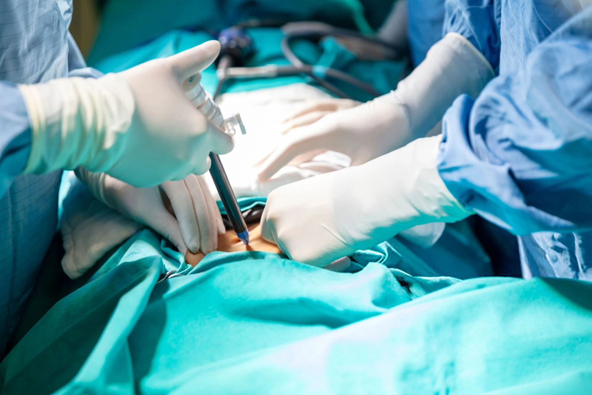 Dr Francisco Rodriguez Vega, colecistectomía laparoscópica